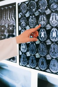 The Prefrontal Cortex_Emotional dysregulation